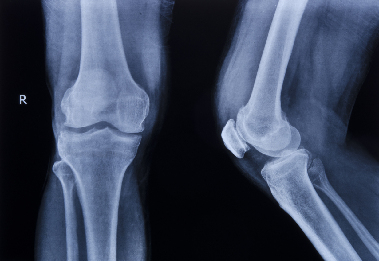 What Does It Mean If My X-Rays Are Negative After an Injury?