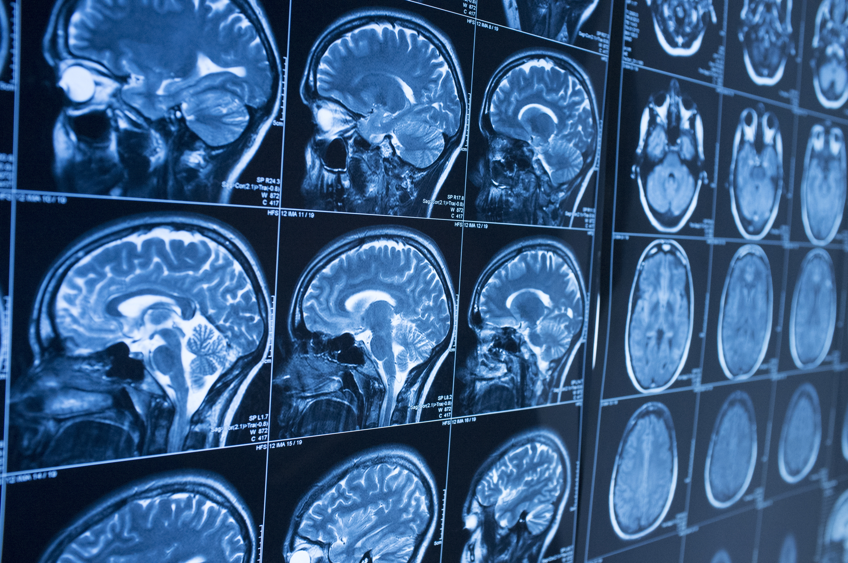How Is a Brain Injury Case Valued in Florida?